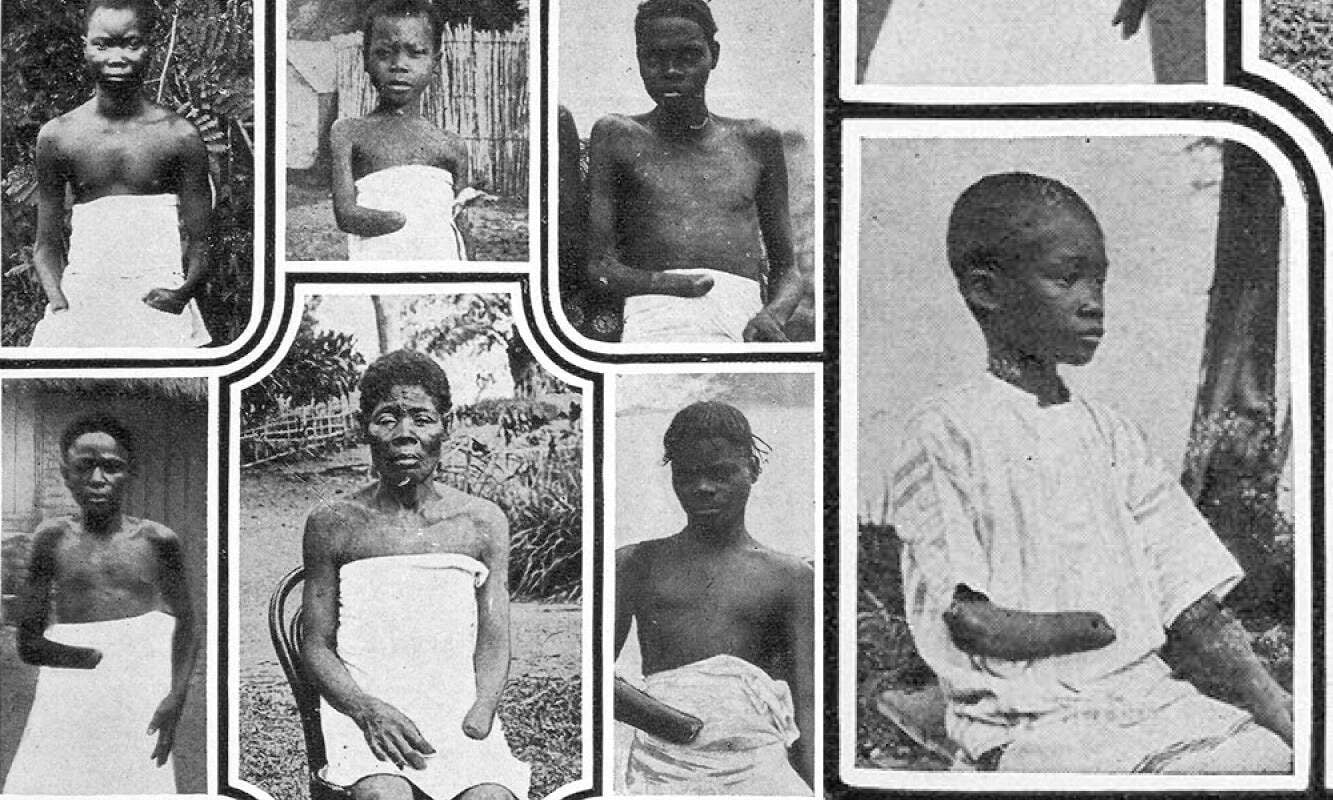 Kral Leopold II'nin sömürgesi altında elleri kesilen Kongolu çocuklar | Kaynak: Alice Harris, Daniel Jacob Danielsen