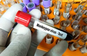 Maymun Çiçeği Virüsü Tespit Edilenlere 21 Günlük Karantina